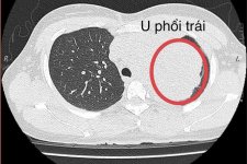 Nữ bệnh nhân ung thư phổi vì người nhà nghiện thuốc lá