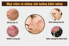 Cẩm nang trị mụn viêm sưng đỏ tại nhà an toàn và hiệu quả