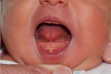 Nhận biết sớm dính thắng lưỡi ở trẻ sơ sinh