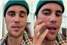 Justin Bieber ngưng hát để tập trung điều trị liệt cơ mặt