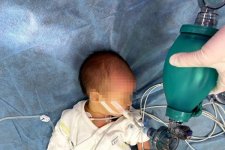 Bé sơ sinh 7 ngày tuổi nhập viện tím tái toàn thân vì sặc sữa