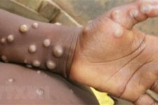 Bệnh đậu mùa khỉ đã lan đến 30 quốc gia