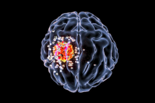 Tin Úc: Hạt nano silica mới là đột phá trong điều trị ung thư não