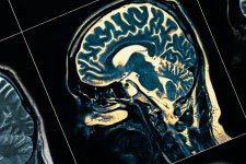 Đột phá mới trong nghiên cứu về chứng Alzheimer