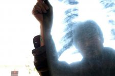 Tin Úc: Bụi silic sẽ gây ra bệnh ung thư phổi cho 10,000 người