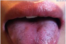 3 biểu hiện bất thường ở lưỡi liên quan đến bệnh tim, nếu có dù chỉ một cái cũng nên đi khám ngay