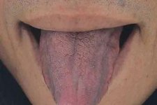 Hình dạng lưỡi bất thường có thể là dấu hiệu bệnh tuyến giáp, nguy cơ chuyển thành ác tính