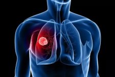 Ung thư phổi và những dấu hiệu cảnh báo sớm