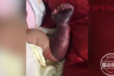 Bé sơ sinh suýt mất cánh tay vì sự cẩn thận quá mức của người mẹ