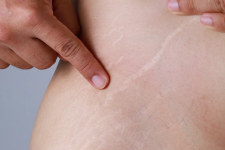 Rạn da do sinh nở có tự hết không và có cần chữa trị?