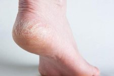 Cách chăm sóc gót chân khô nứt nẻ