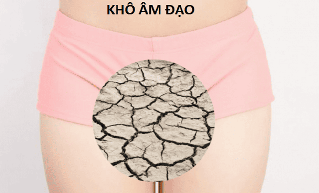 Sự sụt giảm estrogen gây khô âm đạo ở phụ nữ mãn kinh. Ảnh minh họa.