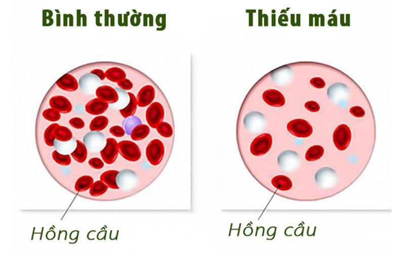 Thiếu máu là nguyên nhân gây tay chân lạnh.