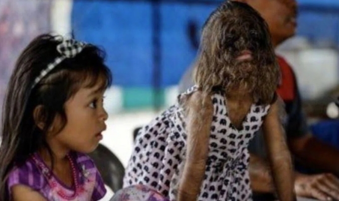 Bé Misclyen ( phải) mắc chứng rậm lông toàn thân bẩm sinh lần đầu đến trường. Ảnh: The Star