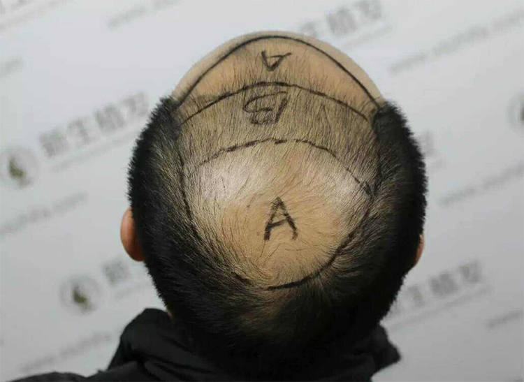Một thanh niên được xác định vùng tóc cấy trước khi thủ thuật cấy tóc diễn ra tại một bệnh viện ở Bắc Kinh, Trung Quốc. Ảnh: Baidu