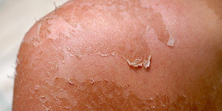 Việc tẩy tế bào chết cho da bị cháy nắng là không nên vì việc chà xát sẽ khiến da càng tổn thương hơn.