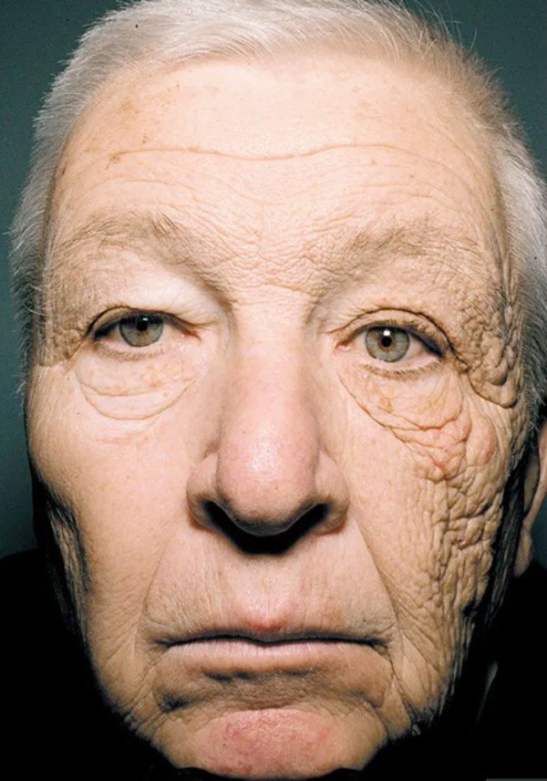 Tác động của ánh nắng mặt trời trên da có thể nhìn thấy rõ trên gương mặt người đàn ông khi nửa bên phải thường xuyên tiếp xúc với ánh nắng còn nửa bên trái thì không. 