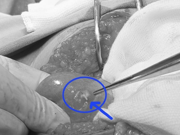 Dị vật tăm tre trong ruột bệnh nhân ở Tuyên Quang
