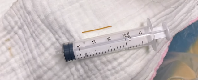 Dị vật tăm tre được lấy ra trong bụng bệnh nhân ở Quảng Bình