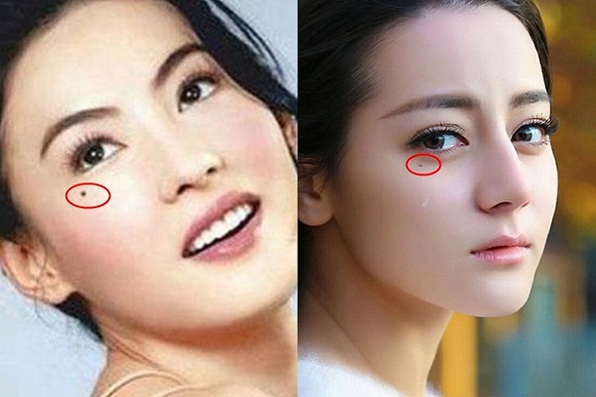 10 nốt ruồi lận đận: Ai có một đời xui xẻo, dễ tai ương - Hình 7 10 not ruoi lan dan: Ai co mot doi xui xeo, de tai uong-Hinh-7