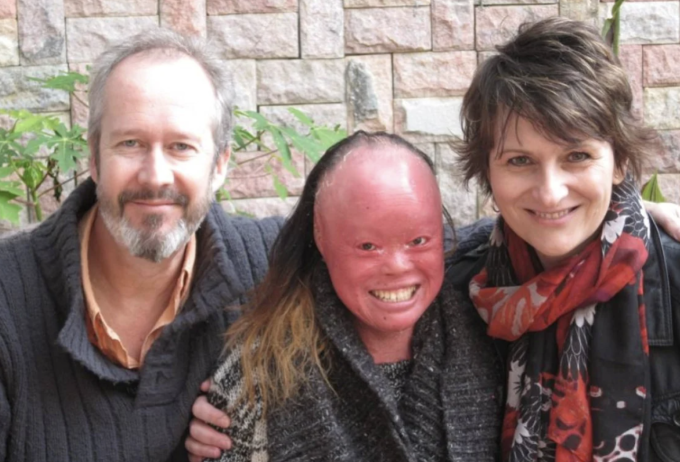 Rog và Tina Thomas bên con gái nuôi Mui, người mắc bệnh vảy cá Harlequin, ở Trung Quốc. Ảnh: SCMP