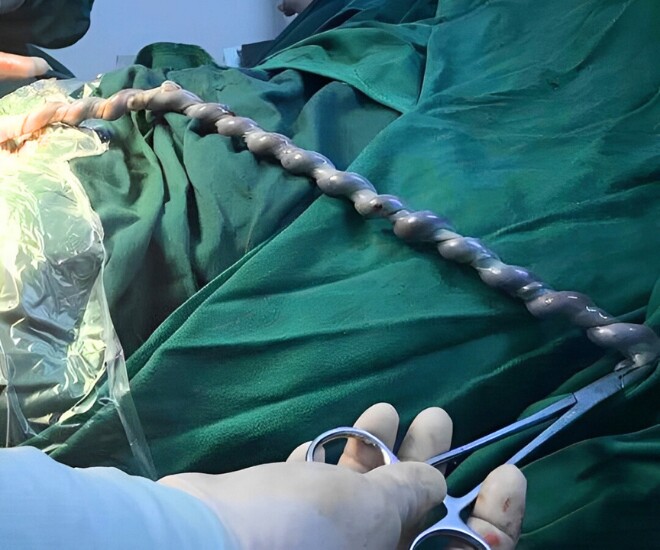 Bác sĩ tá hoả khi dây rốn thai nhi xoắn tới 30 vòng.