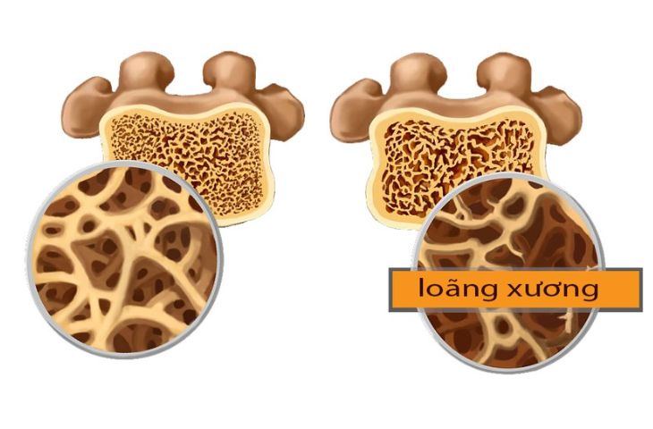 Loãng xương xảy ra khi mật độ khoáng chất của xương giảm, dẫn đến xương có thể gãy khi bị ngã nhẹ
