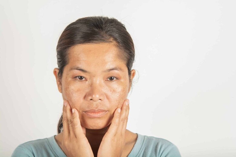 Hydroquinone có thể là “bạn thân” với những chị em gặp phải vấn đề về thâm nám, nhưng cũng sẽ khiến tình trạng tệ đi nếu tiếp xúc trực tiếp dưới ánh mặt trời 