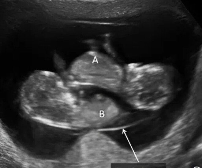 Mẹ bầu Trung Quốc nhận tin vui bất ngờ khi siêu âm thai ở tháng thứ 8 - Ảnh minh hoạ.