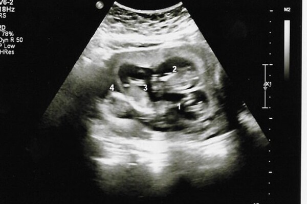 Nghĩ mang song thai, người phụ nữ hoang mang khi 3 lần siêu âm bác sĩ lại thông báo “còn em bé khác” - 1