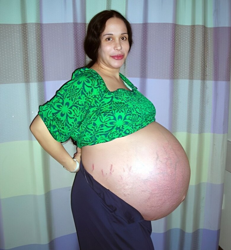 Chiếc bụng rạn chằng chịt của người mẹ khi mang bầu 8 bé.