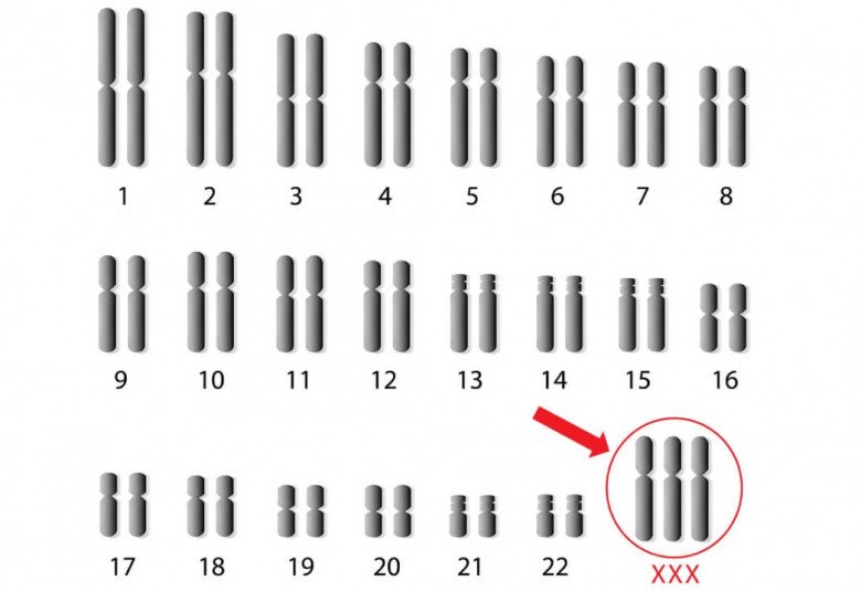 Hội chứng siêu nữ là khi bé gái chào đời bị thừa một nhiễm sắc thể X. Ảnh minh họa. 