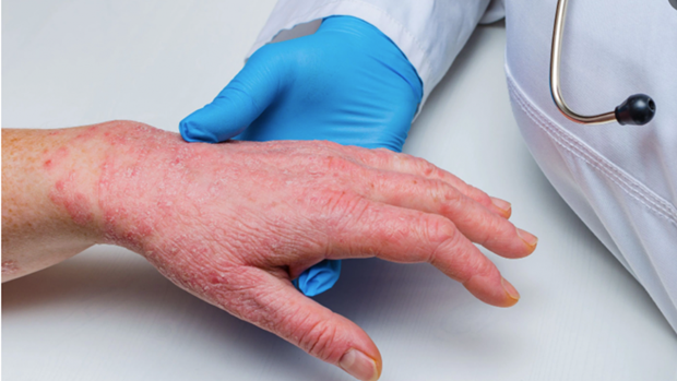 Sự lây lan âm thầm của bệnh đậu mùa khỉ có thể là lời cảnh tỉnh hình ảnh 1 Su lay lan am tham cua benh dau mua khi co the la loi canh tinh hinh anh 1