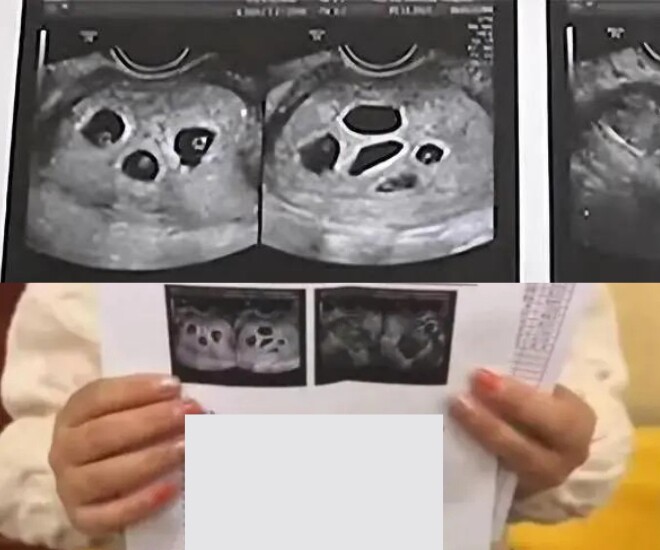 Cô gái họ Bạch tá hoả khi bác sĩ thông báo đang mang bầu 8 bé.