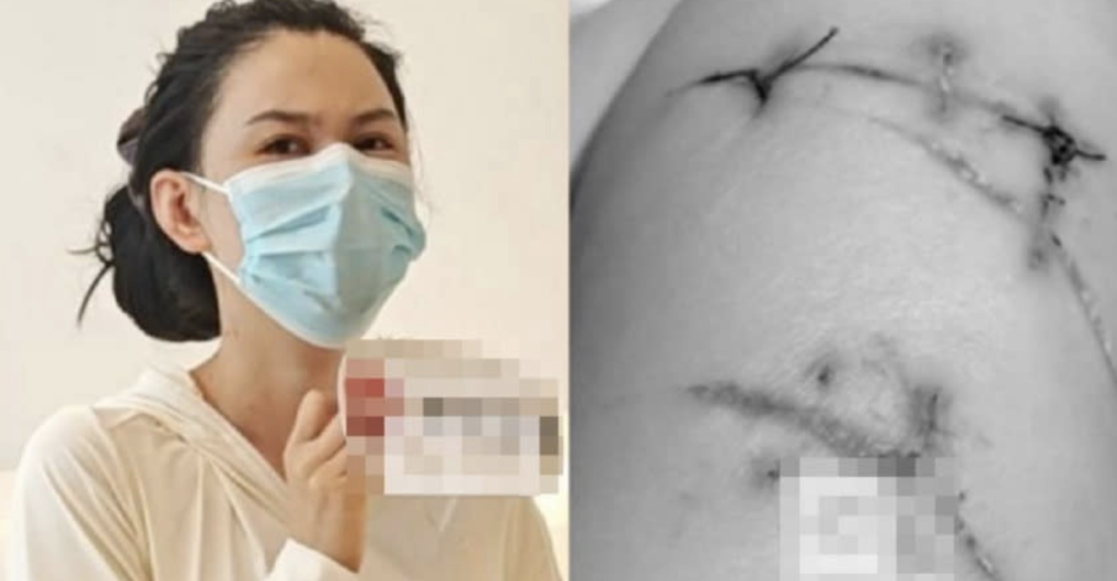 Cô Ma hồi phục sức khỏe sau thời gian điều trị (bên trái) tại bệnh viện ở Hàng Châu và một số vết thương đã được khâu (bên phải). Ảnh: Weibo