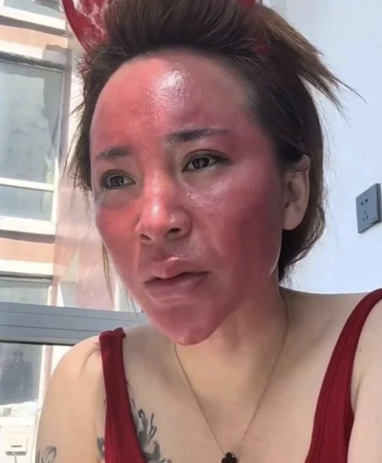 Gương mặt đỏ au của người phụ nữ sau 22 năm không làm sạch da sau mỗi lần trang điểm.