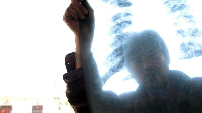 Exposure to silica dust can lead to deadly lung and respiratory diseases, including silicosis.