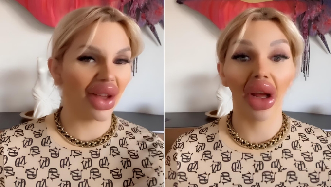 Vienna Wurstel không khép được miệng vì đôi môi đầy. Ảnh: titty_twins