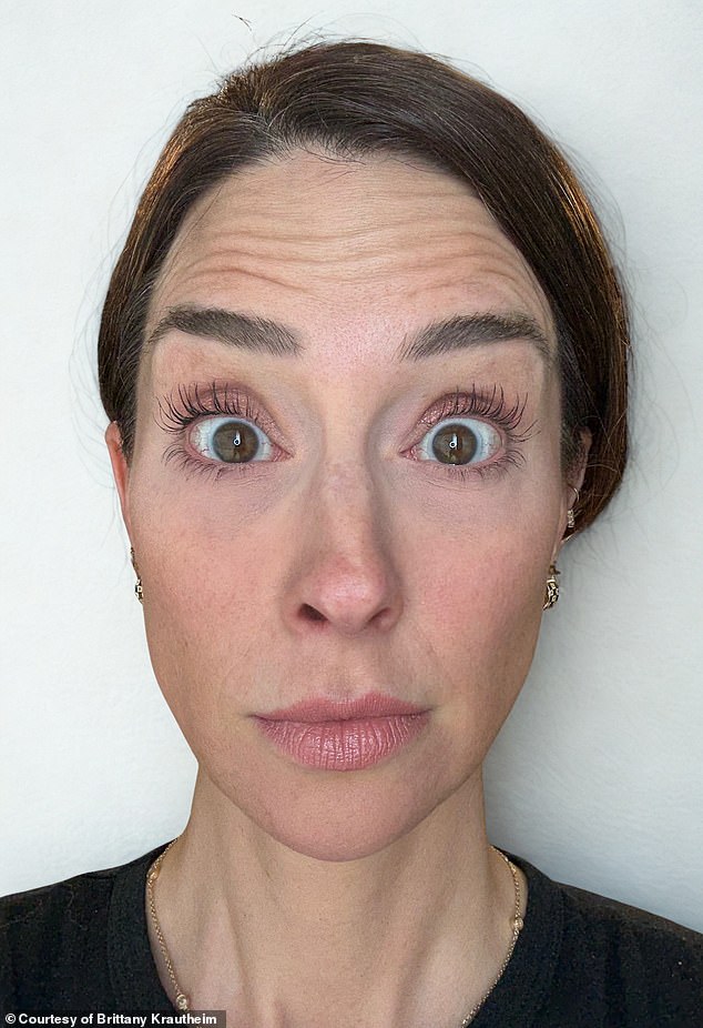 Tiêm botox vào một nửa khuôn mặt để xem ảnh hưởng thế nào đến vẻ bề ngoài: Nữ y tá "gây sốt" khi hé lộ kết quả!- Ảnh 2.