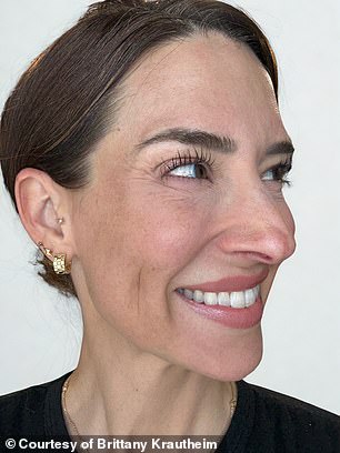 Tiêm botox vào một nửa khuôn mặt để xem ảnh hưởng thế nào đến vẻ bề ngoài: Nữ y tá "gây sốt" khi hé lộ kết quả!- Ảnh 4.