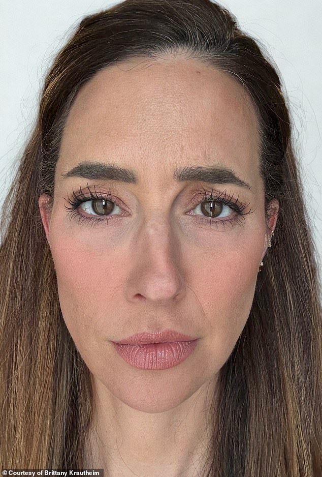 Tiêm botox vào một nửa khuôn mặt để xem ảnh hưởng thế nào đến vẻ bề ngoài: Nữ y tá "gây sốt" khi hé lộ kết quả!- Ảnh 7.