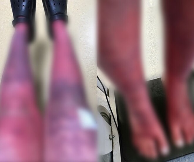 Tình trạng phát ban đỏ toàn thân xuất hiện khi mang thai và sau sinh.