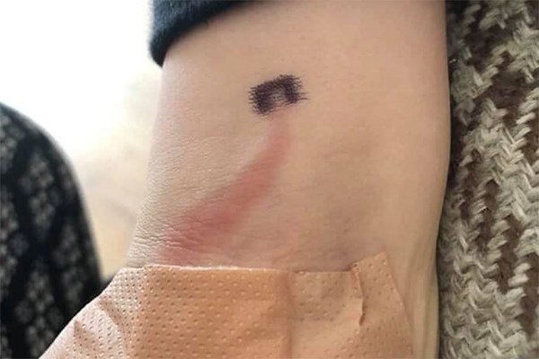 Người mẹ phát hiện con mắc bệnh nguy hiểm nhờ vết đỏ trên cánh tay