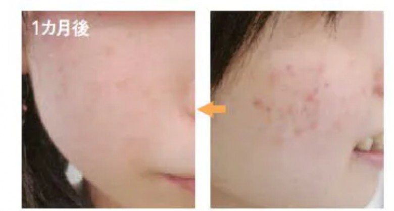 Một thí nghiệm của Nhật cho thấy sự thay đổi của làn da sau một thời gian rửa mặt với đường.