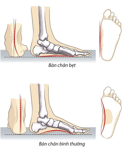 Trẻ em đi dép Crocs lâu ngày dễ ảnh hưởng tới sự phát triển của bàn chân, có thể dẫn đến vấn đề bàn chân bẹt.