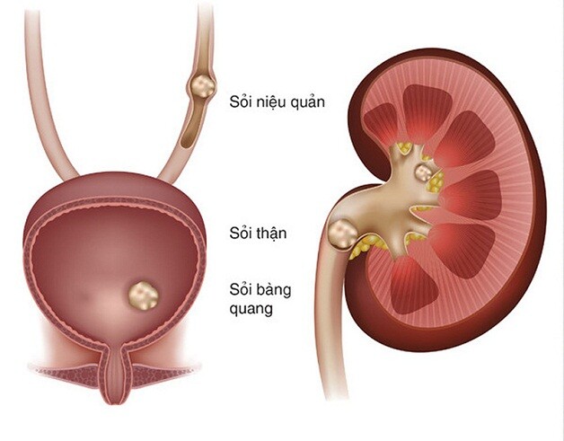 Các loại sỏi cơ bản. (Ảnh minh họa).