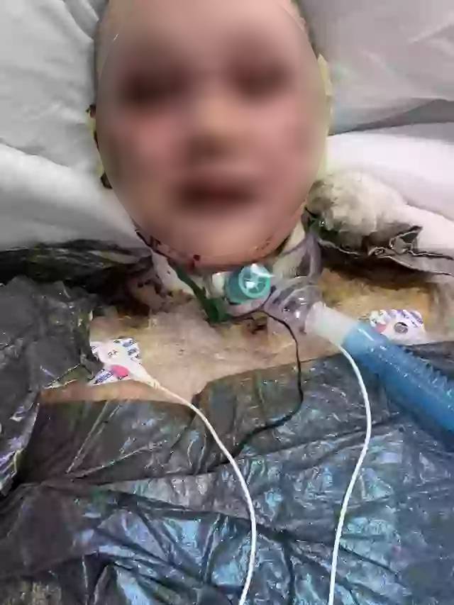 Cơn ác mộng của người mẹ sau sinh con thứ ba: Mất 90-95% da toàn cơ thể, chỉ còn 5% cơ hội sống chỉ vì một loại thuốc giảm đau quen thuộc- Ảnh 2.