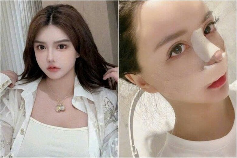 Gương mặt biến dạng của Hàn An Nhiễm sau 33 lần phẫu thuật thẩm mỹ.