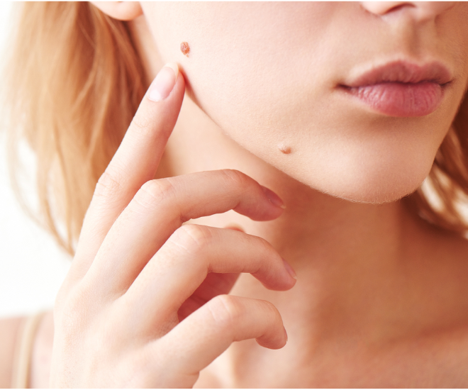 Nốt ruồi là một phần rất phổ biến trên da, nhưng một số loại nốt ruồi có thể là dấu hiệu của u hắc tố. (Ảnh minh hoạ).