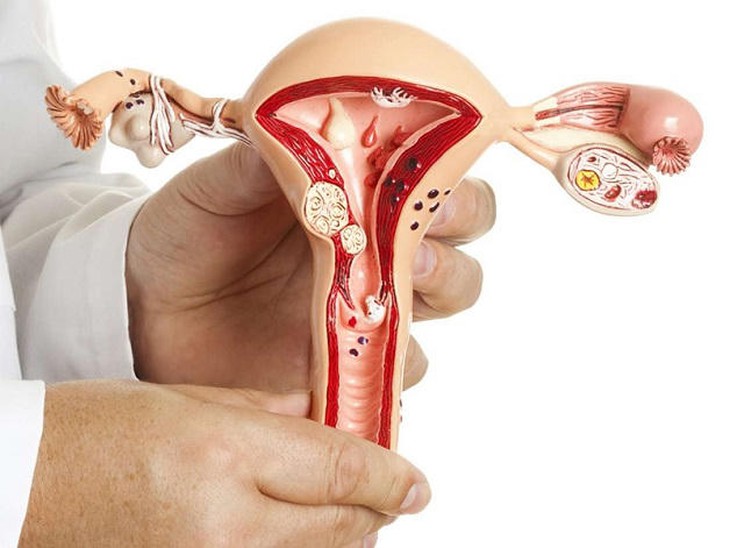 Nữ giới ở độ tuổi từ 30 đến 50 là đối tượng có nguy cơ cao xuất hiện nhân xơ tử cung.